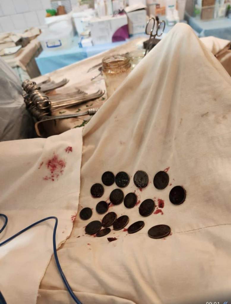 Врач из РостГМУ нашла 26 монет в желудке во время операции